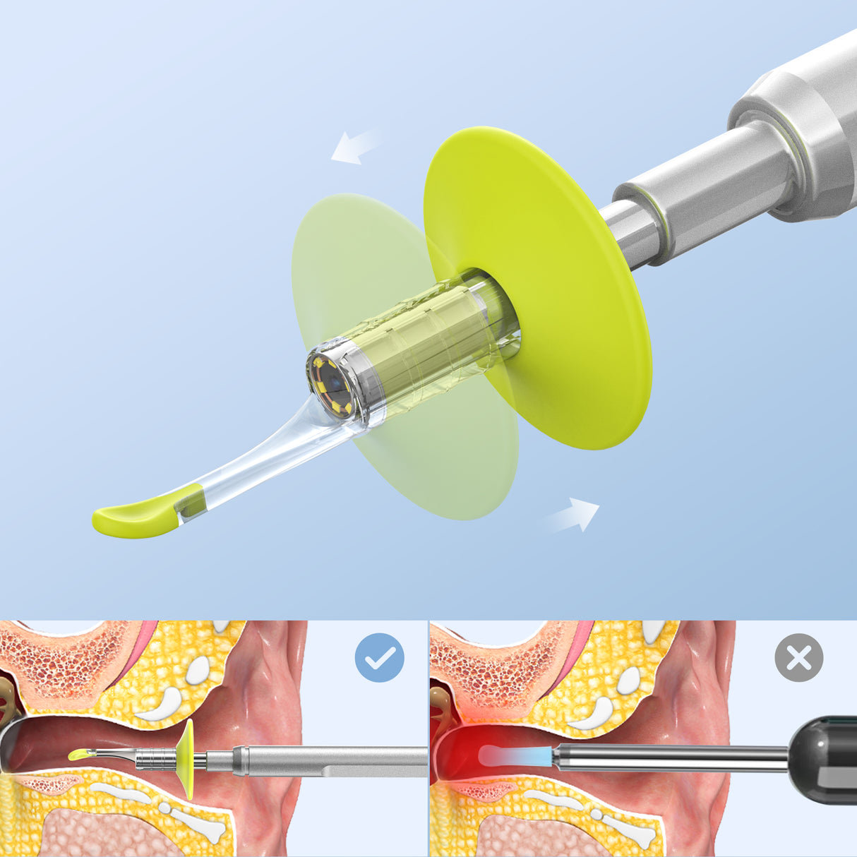 Ear Wax Removal Tool, Replacement Ear Spoon Tips Ear Cleaner, Ear Pick for Anykit Otoscope, Ear Wax Remover Pack of 3. (Green w/ 2 Size)